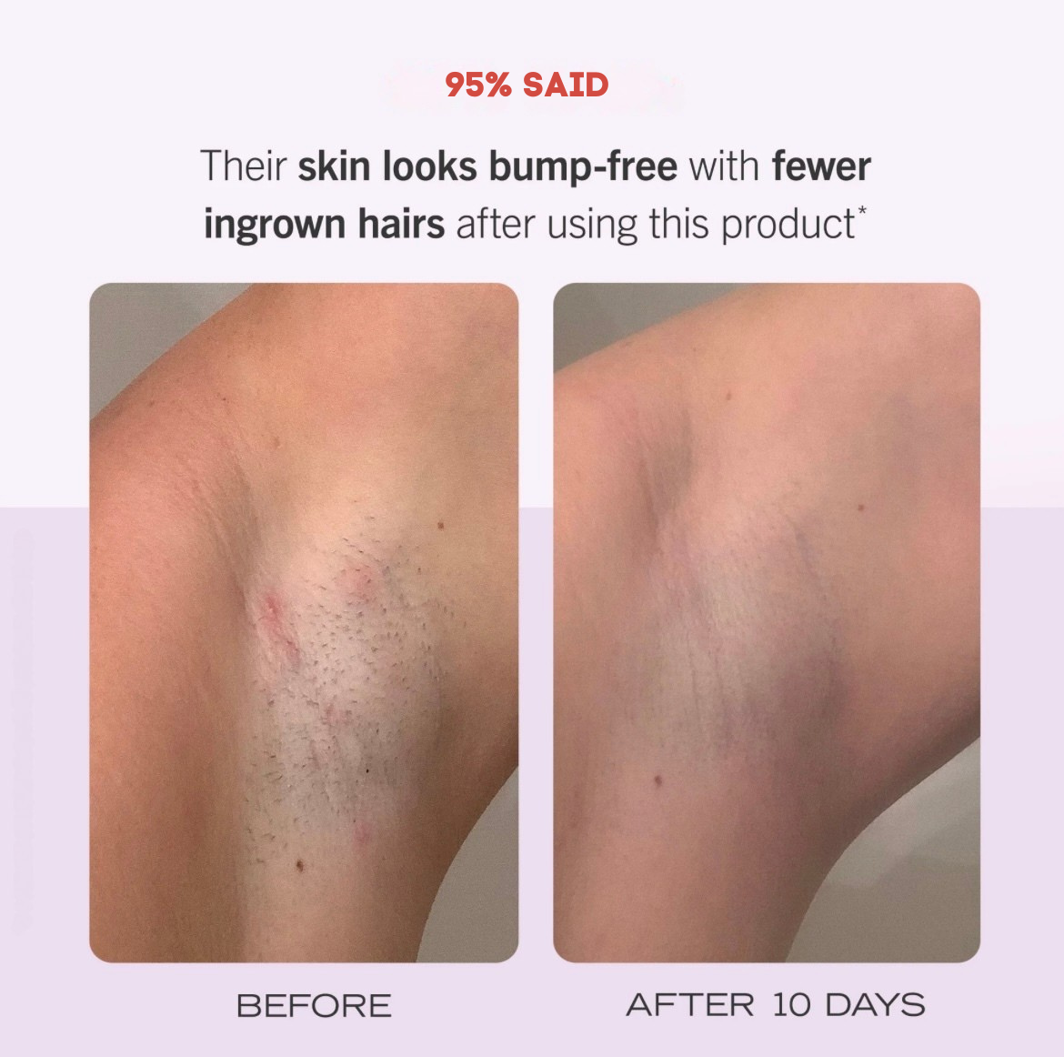 Ingrown Hair Roller Serum